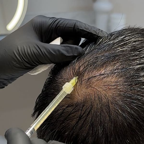 Platelet Rich Plasma (PRP)